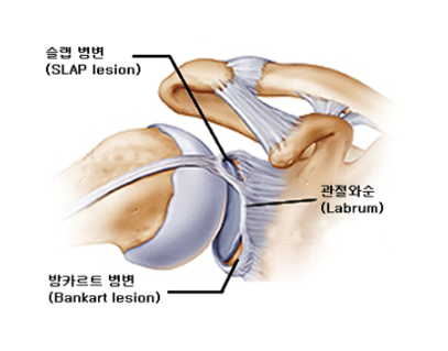 어깨 탈구의 모든 것: 방카르트 병변(Bankart lesion)과 슬랩 병변(SLAP lesion)