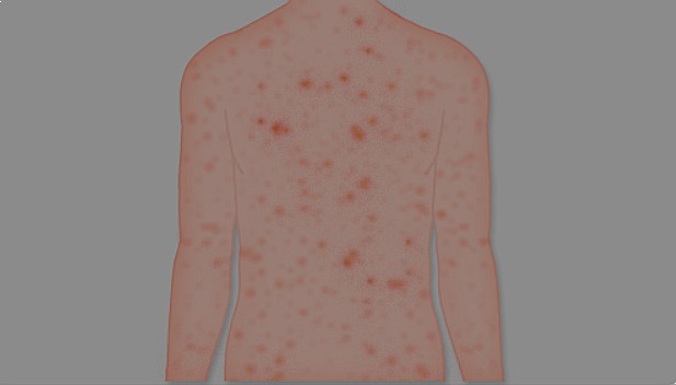 풍진(Rubella, German measles)