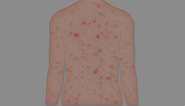 풍진(Rubella, German measles)