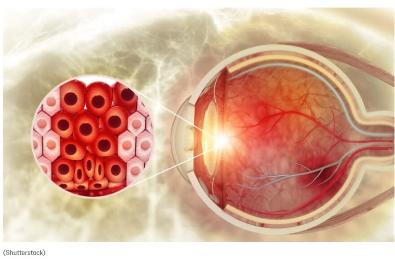 코로나19 백신 접종 후 시력 장애...의사들 위험 경고 Vision Impairments in Patients After COVID-19 Vaccination, Doctors Caution Possible Risks