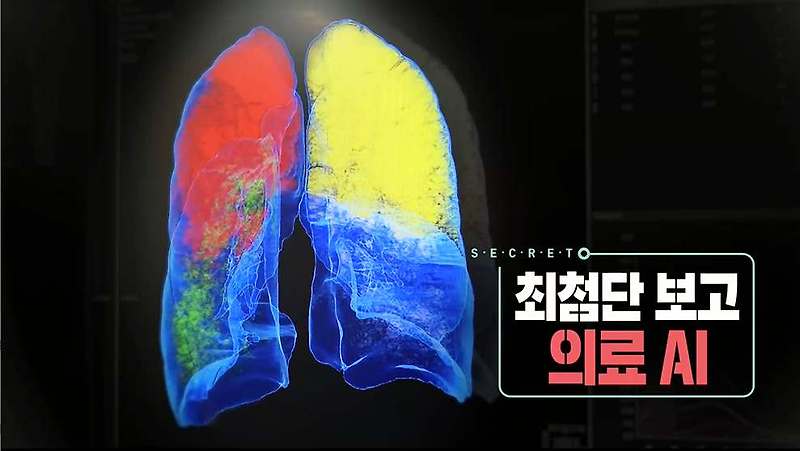 생로병사의 비밀 869회 AI 네비게이션 위암 로봇 수술 진료 예약 방법, 심방세동 예측 심전도, 폐암 조기 발견 인공지능 관련 정보 방법