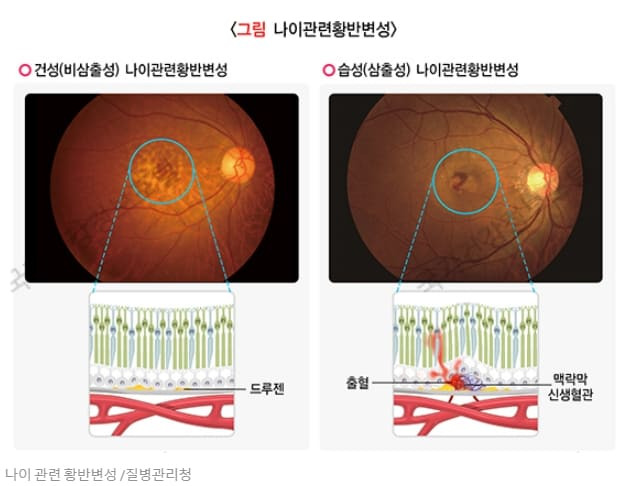 실명 원인 황반변성(AMD), 노화가 아닌 '이것' 때문 The Simple Eating Hack That Could Prevent Most Diseases Including Blindness