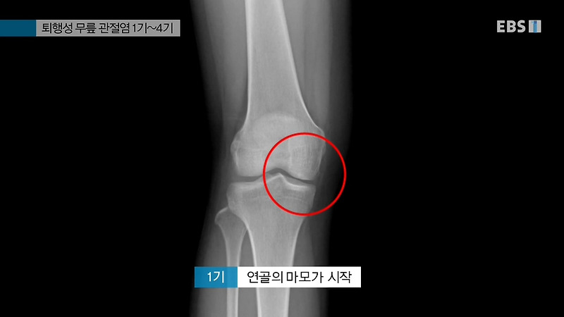 퇴행성 무릎 관절염