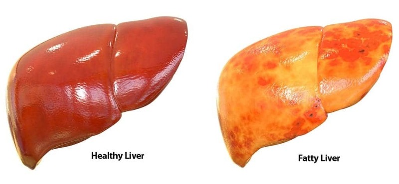 건강검진 지방간(Fatty Liver) 지방간은 뭐길래 4편
