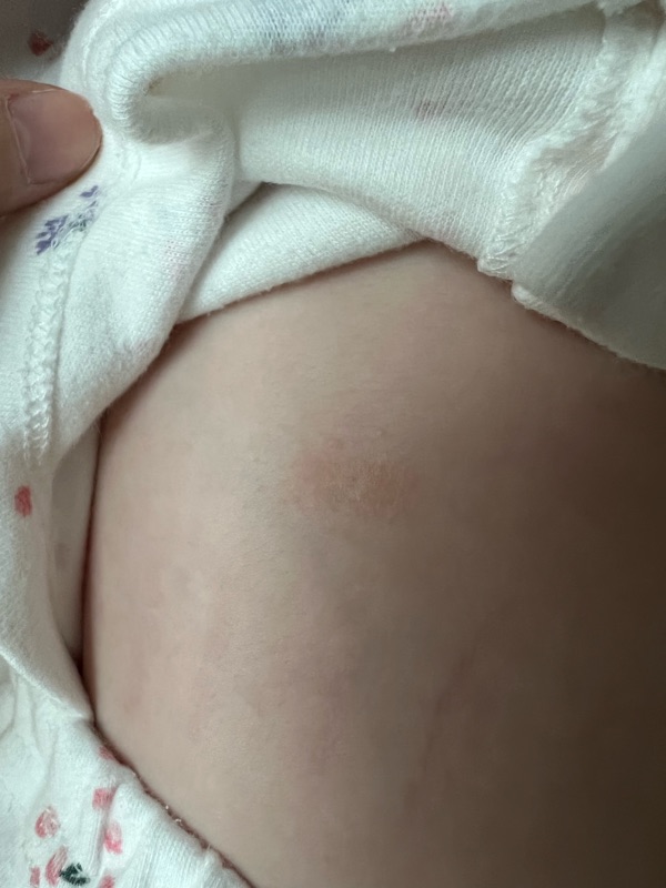 아기 태열 초기 증상 발견, 연고 처방 받아온 후기
