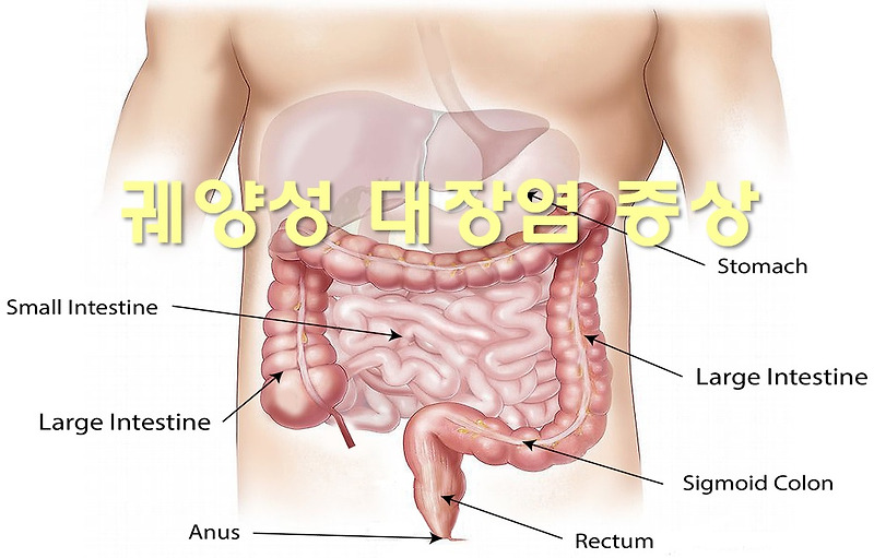 궤양성 대장염 증상과 치료 방법