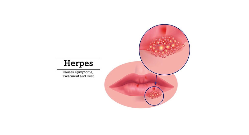 헤르페스 감염의 종류, 증상, 치료방법!