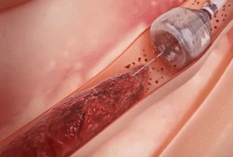 경동맥 내막절제술(Carotid endarterectomy, CEA)