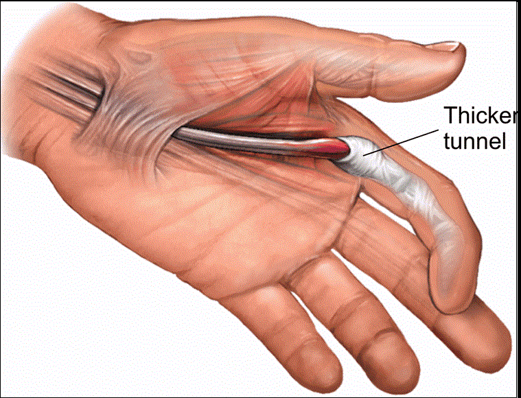 윽! 손가락에서 소리가?...방아쇠 손가락은 당뇨병 징후?..예방법 VIDEO: Hands of People With Diabetes More Often Affected by Trigger Finger