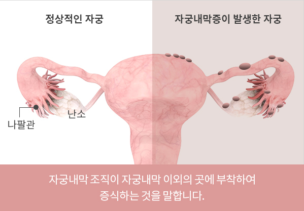 자궁내막증 원인, 유전, 나이, 체중, 월경