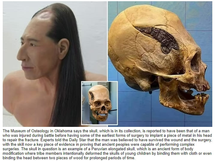 2천년 전 페루인들의 놀라운 수술 기술 VIDEO: 2,000 year-old Peruvian skull may be oldest evidence of SURGERY...