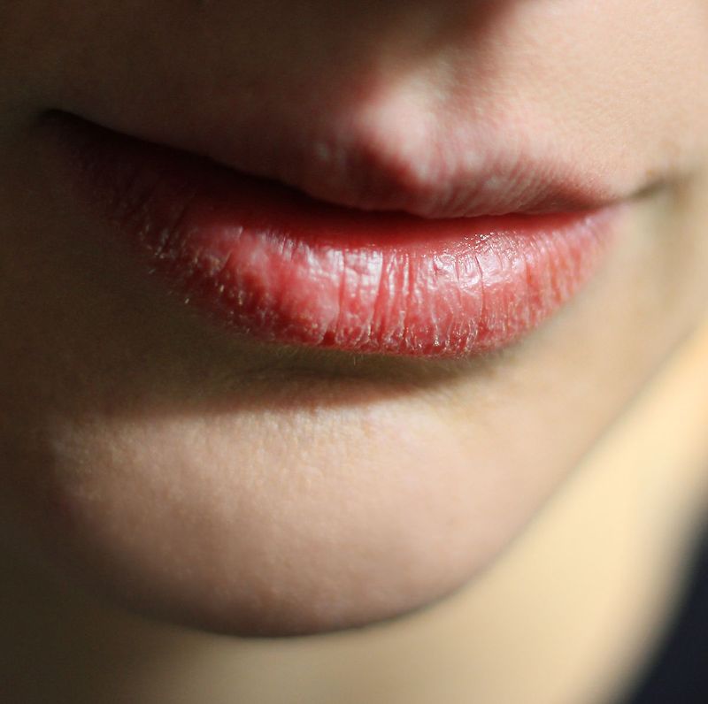 입술 뜯으면 안되는 이유! : 입술 뜯는 습관 고치는 방법, 입술 감염