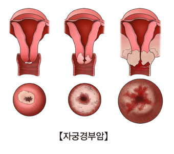 자궁경부암 원인, 초기증상, 자가진단 방법 알아보자 (남자도 걸린다?)