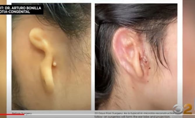 세계 최초 자신의 세포로 만든 3D 프린팅 귀 가져  VIDEO:Woman receives 3D-printed ear made of human cells