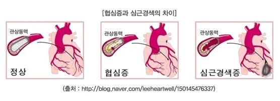 한국, 의료 강국 맞아?...선진국 감소 심근경색 환자 한국만 급증세