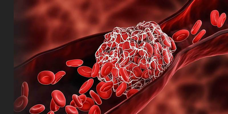 혈전(Thrombus, Blood clot)이란