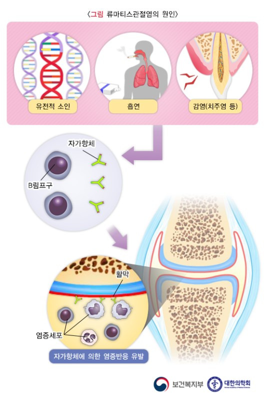 류마티스 관절염 (rheumatoid arthritis)