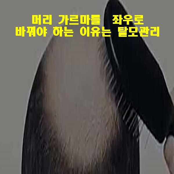 머리 가르마를 좌우로 바꿔야 하는 이유는 탈모관리