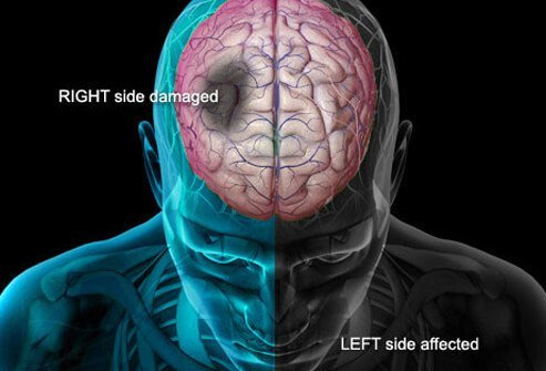 뇌졸중(stroke) 그리고 혈전(Blood clot)의 증상들