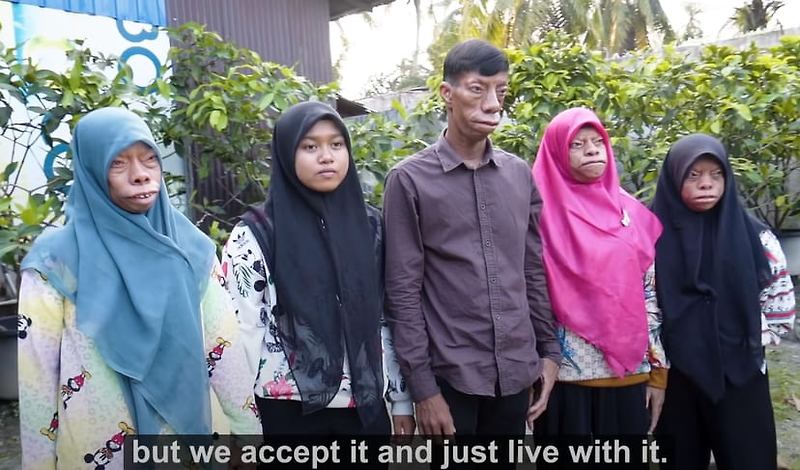 얼굴 모양이 변하는 희귀한 질병을 가진 가족 l 세계에서 가장 큰 코의 소유자 VIDEO:The Family Whose Faces Change Shape | The owner of the largest nose in the world, according to Guinness Book