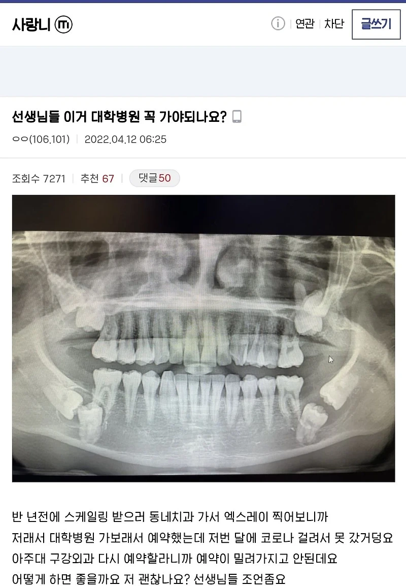 선생님들 이거 대학병원 꼭 가야되나요? (역대급 사랑니 수술후기)