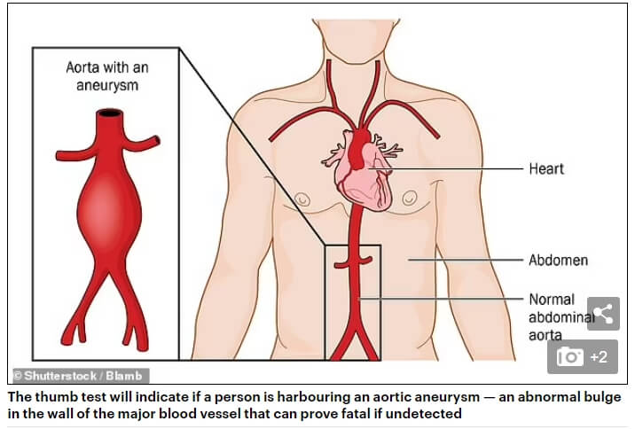 소리 없이 찾아오는 병 대동맥류 간단한 테스트법 VIDEO:Simple thumb test can indicate if you're harbouring an aortic aneurysm - an abnormal bulge....