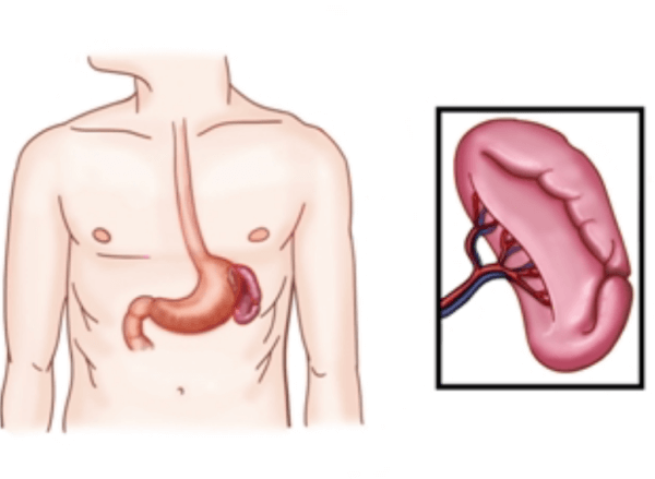 비장절제수술을 해야하는 경우와 주의사항