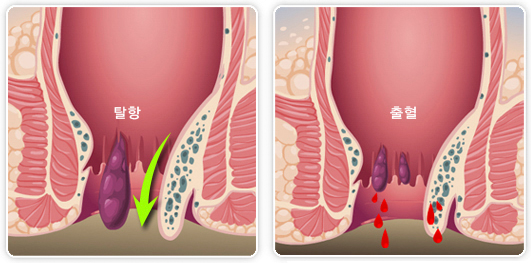 치질 수술 후 회복기간 및 자가 치료법 알아보기