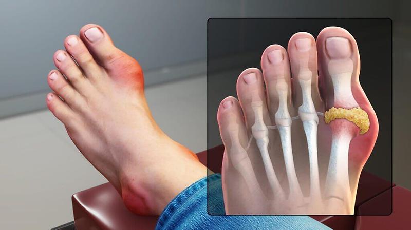 통풍(Gout), 증상 없어도 평생 관리해야...