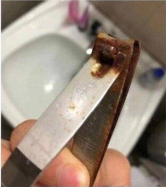 굳은살 제거하다가 발가락 3개 없어져버린 썰