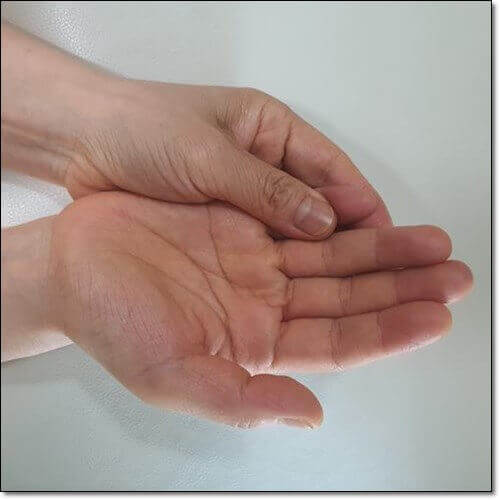 새끼손가락 저림 원인 및 증상과 치료
