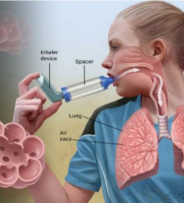 기관지 천식(Bronchial Asthma) 간호