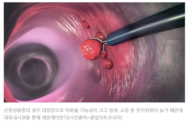 말 많은 대장암 내시경 검사...과연 암 사망률 낮춰줄까...지난해 “사망 예방 효과 없다” 논문 나와