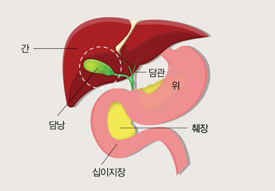 쓸개(담낭) 제거수술 과정 및 후기, 6개월 후 리뷰