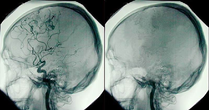 혼수상태와 뇌사상태의 차이점은 무엇인가? What is the Difference Between a Coma and Brain Death?