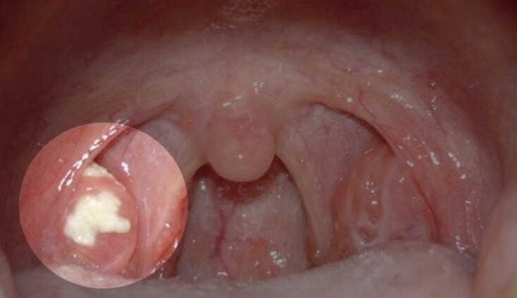 편도결석, 목똥 없애는 법