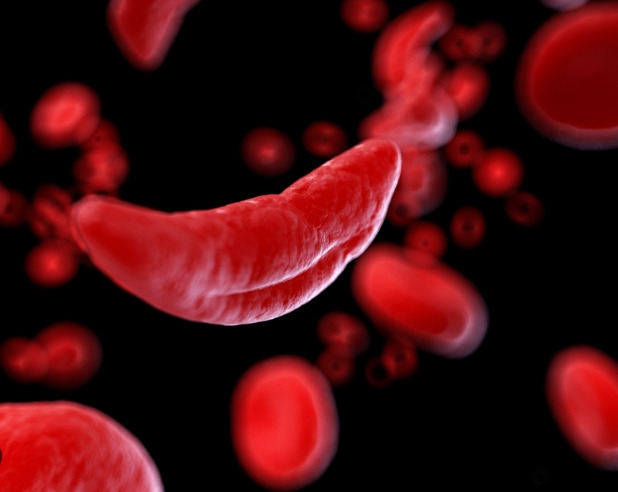 1회 투약 비용이 41억원?: 세계 최고 비싼 약 순위 FDA Approves First Gene Therapies to Treat Patients with Sickle Cell Disease