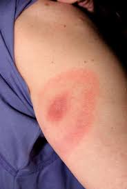 라임병(Lyme disease) : 진드기 물렸을 때, 진드기 발진, 진드기 오한, 진드기 물리고 열