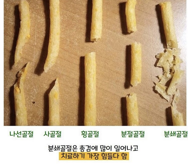 과자로 알아보는 ‘골절의 종류’