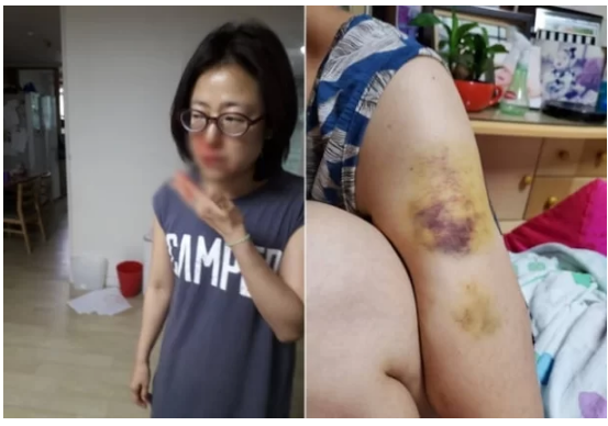 동거남 의혹 황보승희 '난 가정폭력 전남편의 피해자' 피투성이 사진 올려