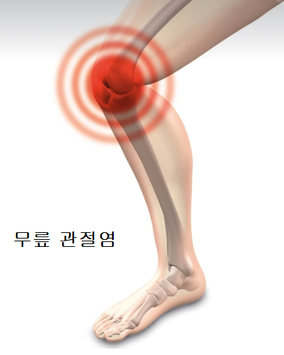 무릎 손가락 관절염 원인 초기증상 및 대처방법