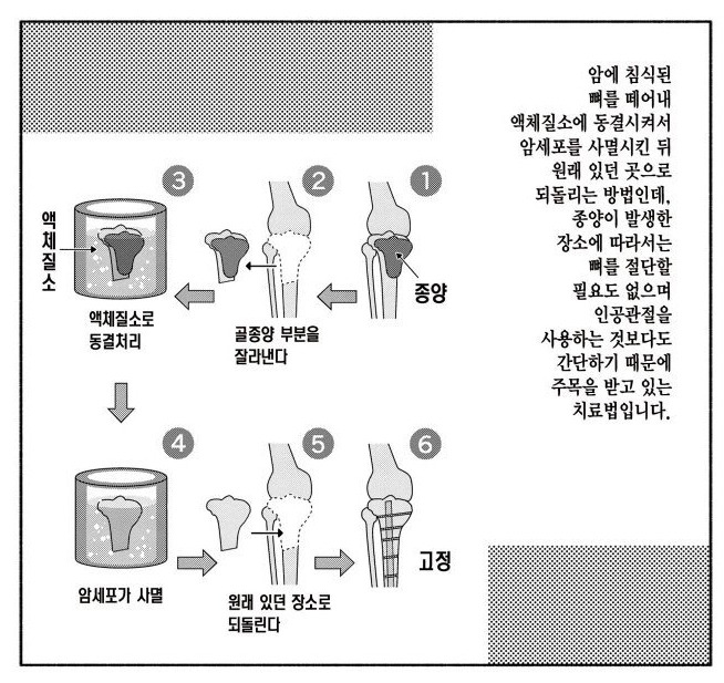 혐주의) 골육종 - 뼈암치료 의학수준 근황