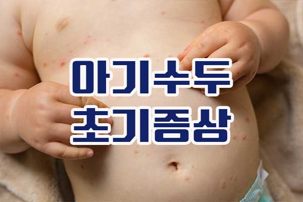 아기 수두 초기증상과 예방접종 및 치료