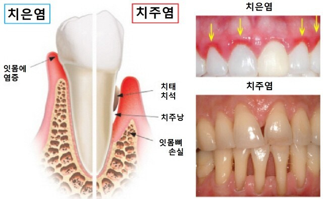 치주염 증상 및 치료법