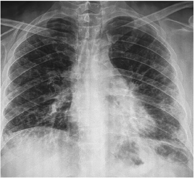 미만성 간질성 폐질환(Diffuse Interstitial Lung Disease, DILD) : 원인, 증상, 치료방법 및 예후