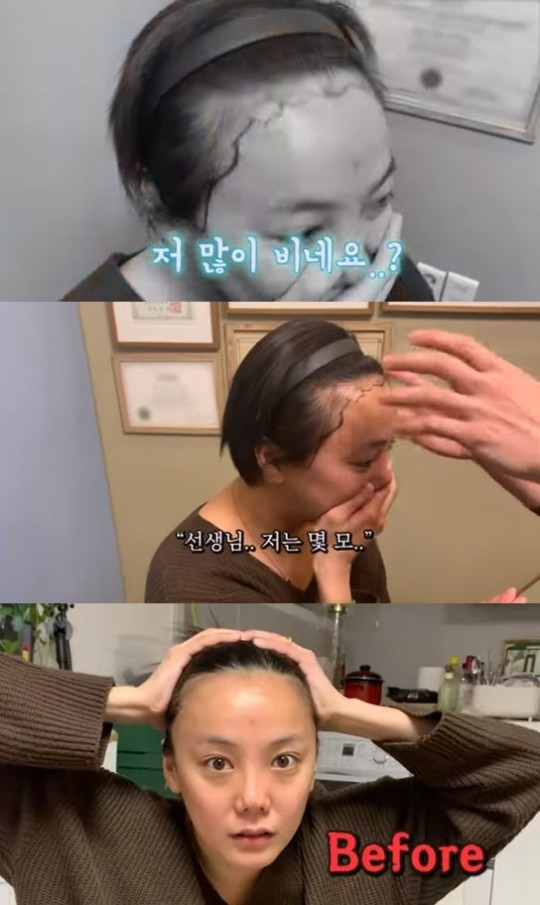 고은아, 머리 심는다 