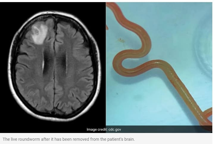 호주 여성 뇌에서 살아있는 기생충 세계 최초 발견 VIDEO: Live parasitic worm found in Australian woman’s brain in world first