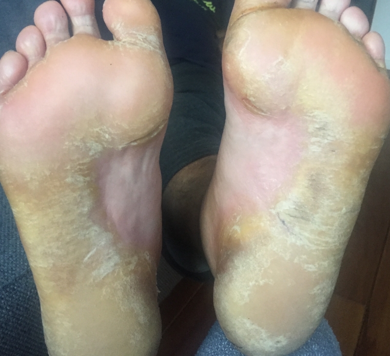 발 습진-가렵고 자극적인 발의 원인 및 예방