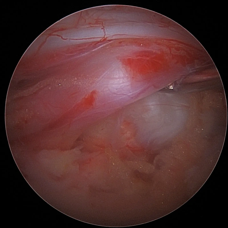 양방향 내시경 디스크 수술 - 허리통증과 오른쪽 허벅지 종아리 발바닥 저린 환자