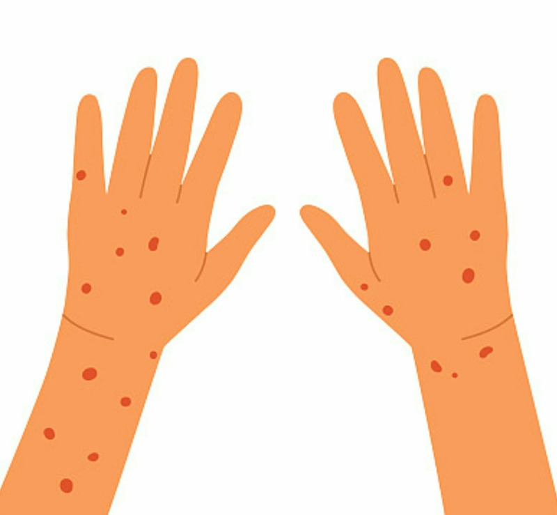 손 급성 만성 습진 원인과 증상 및 진단과 치료 예방